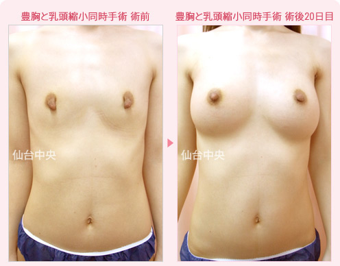 豊胸と乳頭縮小同時手術 症例写真1