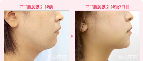 アゴ脂肪吸引