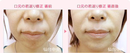 口元の若返り修正