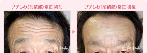 プチしわ(前額部)修正