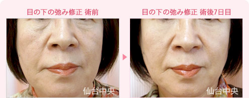 目の下の弛み修正