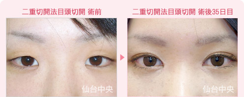 新垣結結衣さん風整形