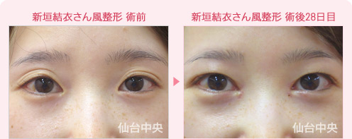 新垣結結衣さん風整形