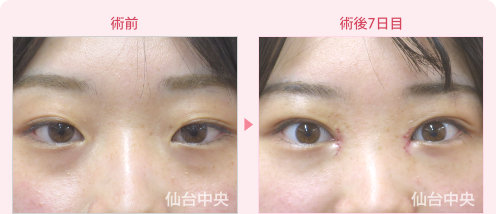腫れない二重埋没法と目頭切開症例写真 - 術前と術後7日目の比較、正面