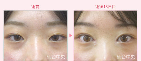 腫れない二重埋没法と目頭切開症例写真 - 術前と術後13日目の比較、正面