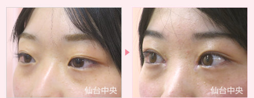 腫れない二重埋没法と目頭切開症例写真 - 術前と術後13日目の比較、左向き