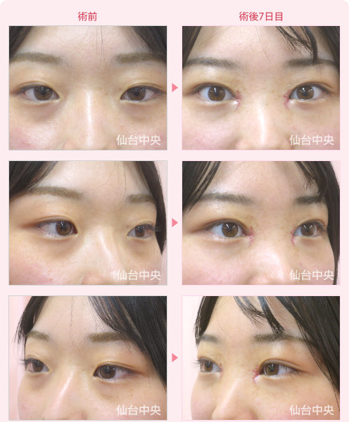 今田美桜さん風整形　症例写真