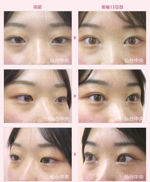 今田美桜さん風整形　症例写真2