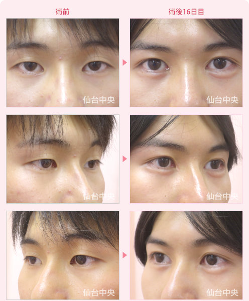 山崎健人さん風整形