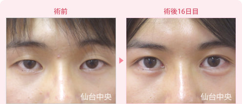 男性二重埋没法、目頭切開症例手術-術前と術後16日目の比較、正面