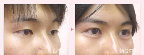 男性二重埋没法、目頭切開症例手術-術前と術後16日目の比較、右向き