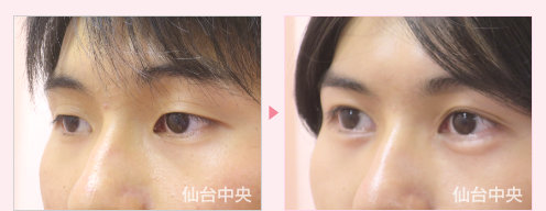 男性二重埋没法、目頭切開症例手術-術前と術後16日目の比較、左向き