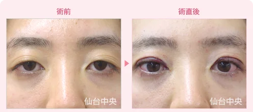 美容外科的腫れない眼瞼下垂手術 症例写真1