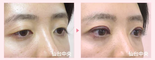 美容外科的腫れない眼瞼下垂手術 症例写真2