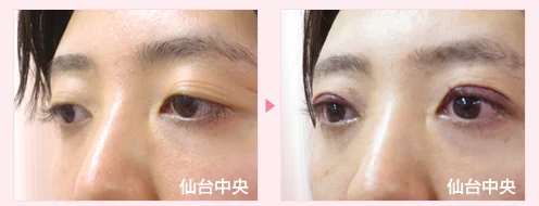 美容外科的腫れない眼瞼下垂手術 症例写真3