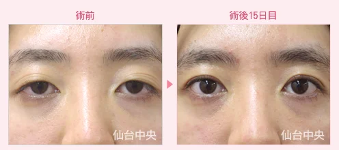 美容外科的腫れない眼瞼下垂手術 症例写真4