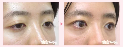美容外科的腫れない眼瞼下垂手術 症例写真5