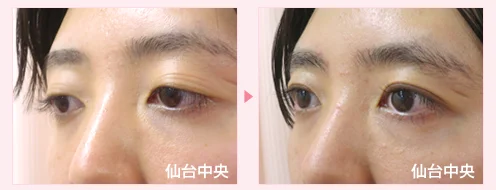 美容外科的腫れない眼瞼下垂手術 症例写真6