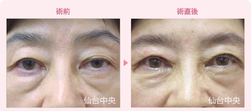 美容外科的腫れない眼瞼下垂手術 症例写真1