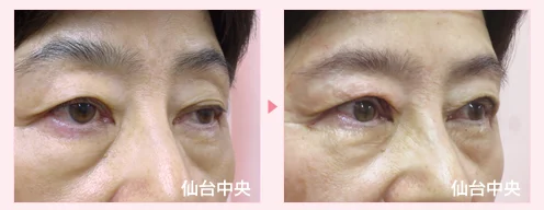 美容外科的腫れない眼瞼下垂手術 症例写真2
