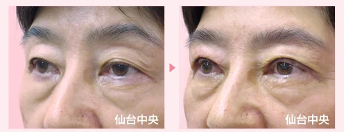 美容外科的腫れない眼瞼下垂手術 症例写真3