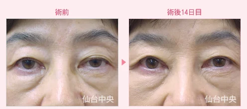 美容外科的腫れない眼瞼下垂手術 症例写真4