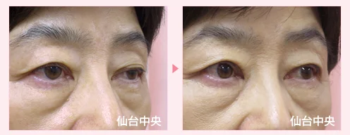 美容外科的腫れない眼瞼下垂手術 症例写真5