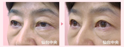 美容外科的腫れない眼瞼下垂手術 症例写真6