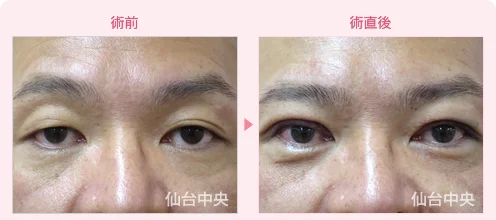 美容外科的腫れない眼瞼下垂手術 症例写真1