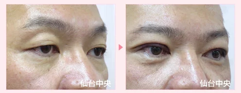 美容外科的腫れない眼瞼下垂手術 症例写真2