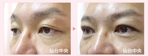 美容外科的腫れない眼瞼下垂手術 症例写真3