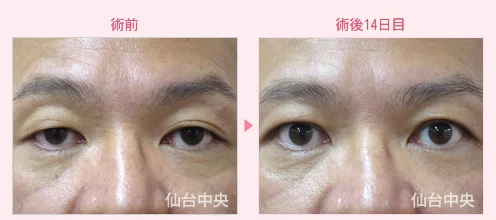 美容外科的腫れない眼瞼下垂手術 症例写真4