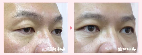 美容外科的腫れない眼瞼下垂手術 症例写真5