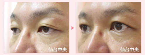 美容外科的腫れない眼瞼下垂手術 症例写真6