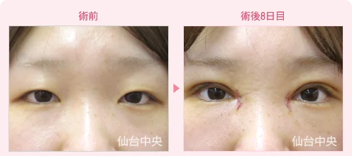 美容外科的腫れない眼瞼下垂手術 症例写真1