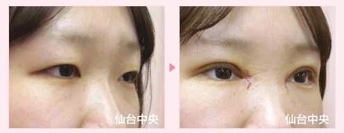 美容外科的腫れない眼瞼下垂手術 症例写真2