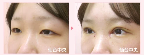 美容外科的腫れない眼瞼下垂手術 症例写真3