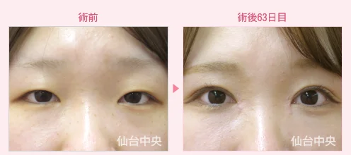美容外科的腫れない眼瞼下垂手術 症例写真4