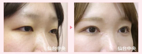 美容外科的腫れない眼瞼下垂手術 症例写真5