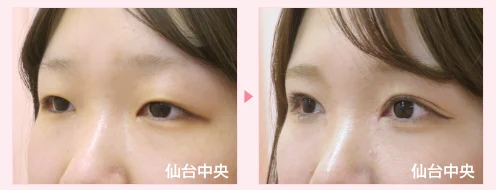 美容外科的腫れない眼瞼下垂手術 症例写真6