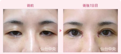 美容外科的腫れない眼瞼下垂手術 症例写真1