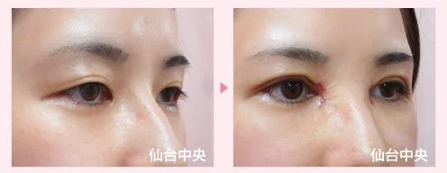 美容外科的腫れない眼瞼下垂手術 症例写真2