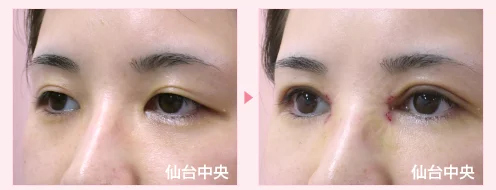 美容外科的腫れない眼瞼下垂手術 症例写真3