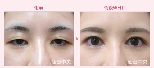 美容外科的腫れない眼瞼下垂手術 症例写真4