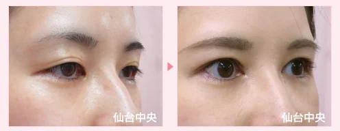 美容外科的腫れない眼瞼下垂手術 症例写真5