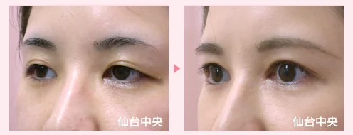 美容外科的腫れない眼瞼下垂手術 症例写真6