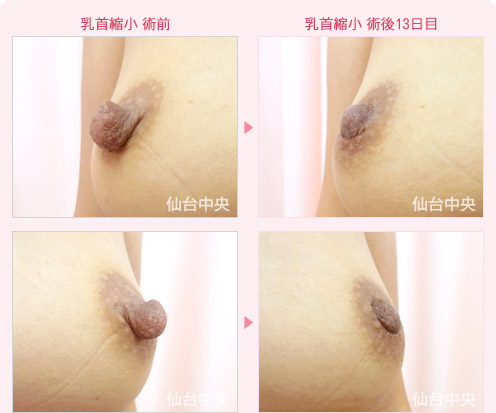 乳首縮小