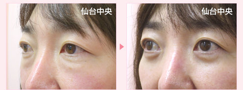 クマ取りと涙袋同時手術 症例写真