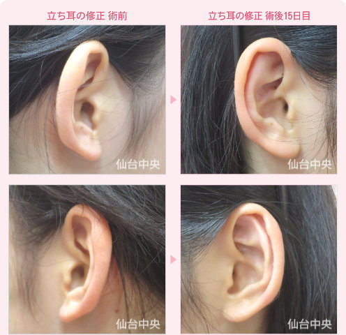 立ち耳修正