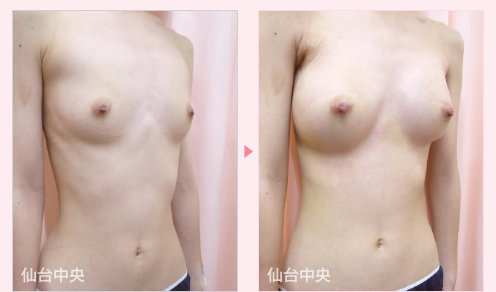 綺麗な美乳作製 症例写真2